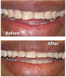 Composite bonding treatment