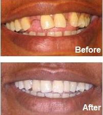 Adhesive bridge to replace a missing front tooth