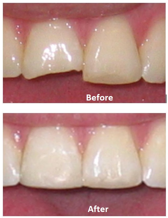 Chipped Tooth Repair