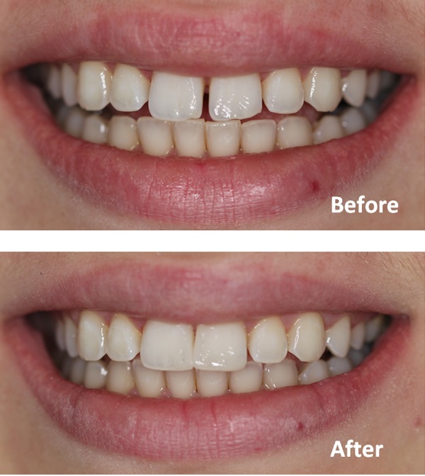Close gaps between front teeth without braces
