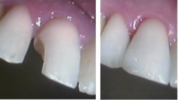 Before and after dental composite bonding
