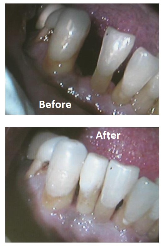 Dental Bridge to Replace Missing Tooth