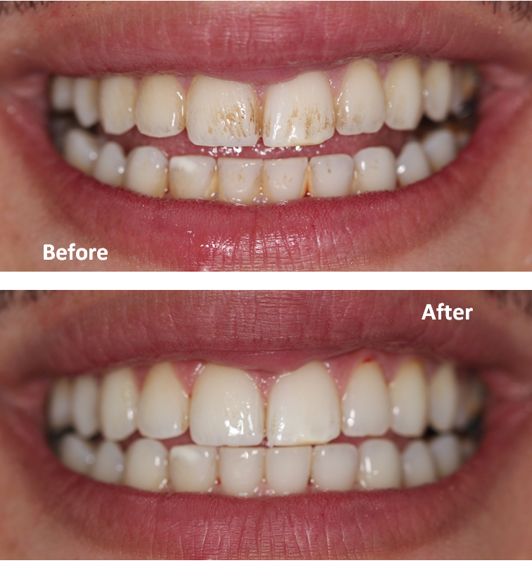 Dental hygiene scale and polish for a brighter smile