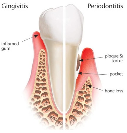 Gum disease