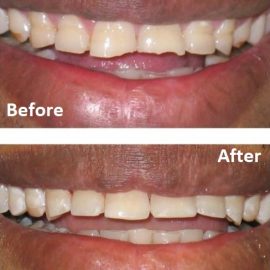 Worn teeth repaired with composite bonding before and after
