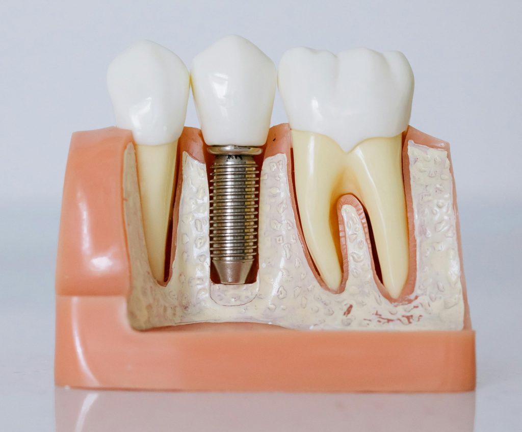 Dental implants