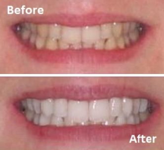 Professional teeth whitening for a whiter smile
