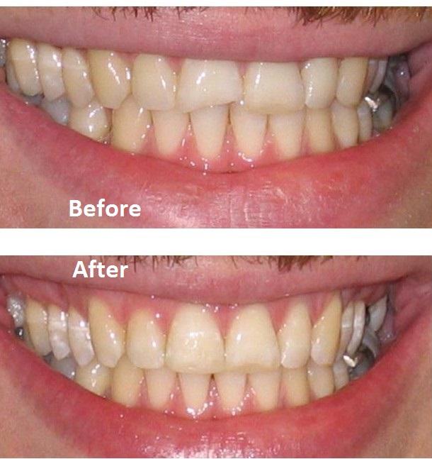 Before and after broken front tooth repair with composite bonding