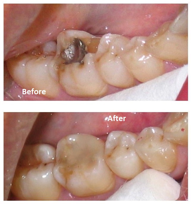 Dental bonding in Ealing