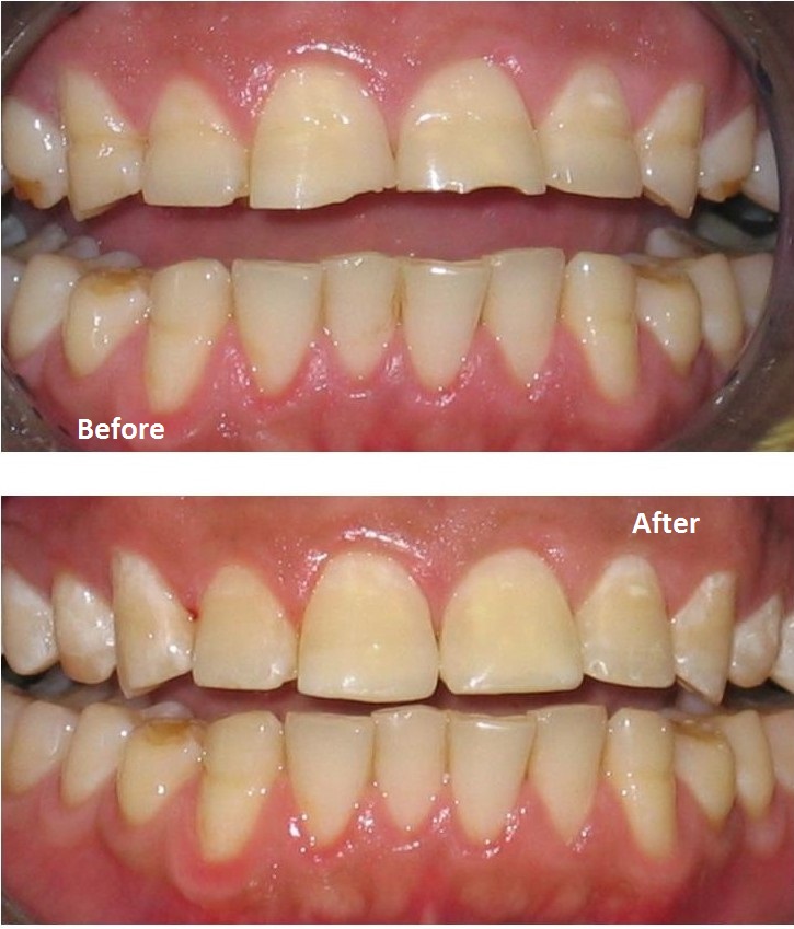 Worn teeth before and after composite bonding treatment