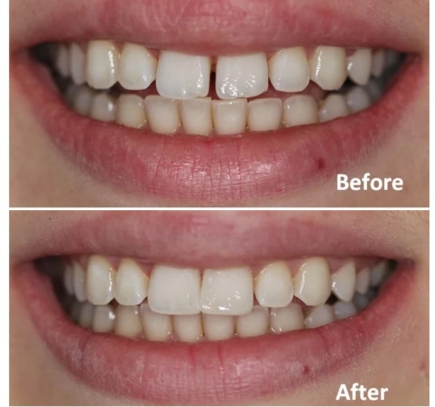 Dental bonding in Ealing
