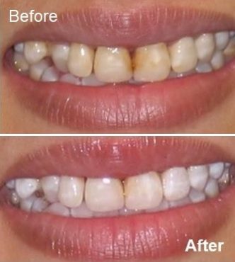 Teeth whitening before and after photos