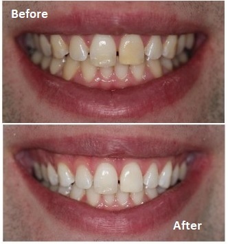 Teeth whitening results dentist Ealing