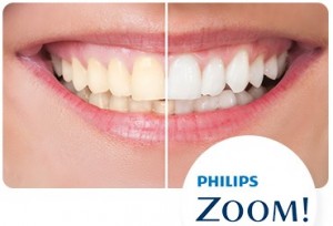 Teeth whitening maintenance advice