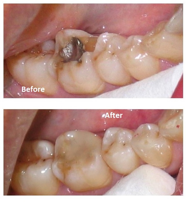 Composite bonding in Ealing